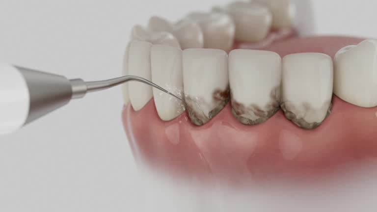 Reliable Dental Implants contractor in Punta Rassa, FL by Smile Center Dentistry